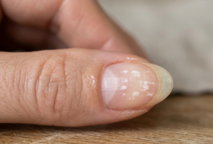 Manchas brancas nas unhas: entenda as causas reais e quando buscar ajuda médica