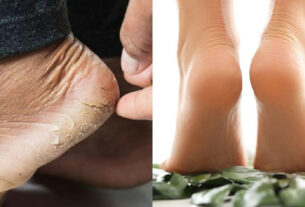 Como tratar calcanhares rachados com uma mistura caseira simples de três ingredientes