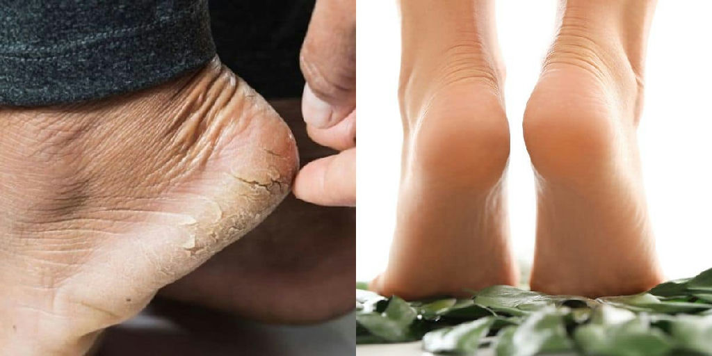 Como tratar calcanhares rachados com uma mistura caseira simples de três ingredientes